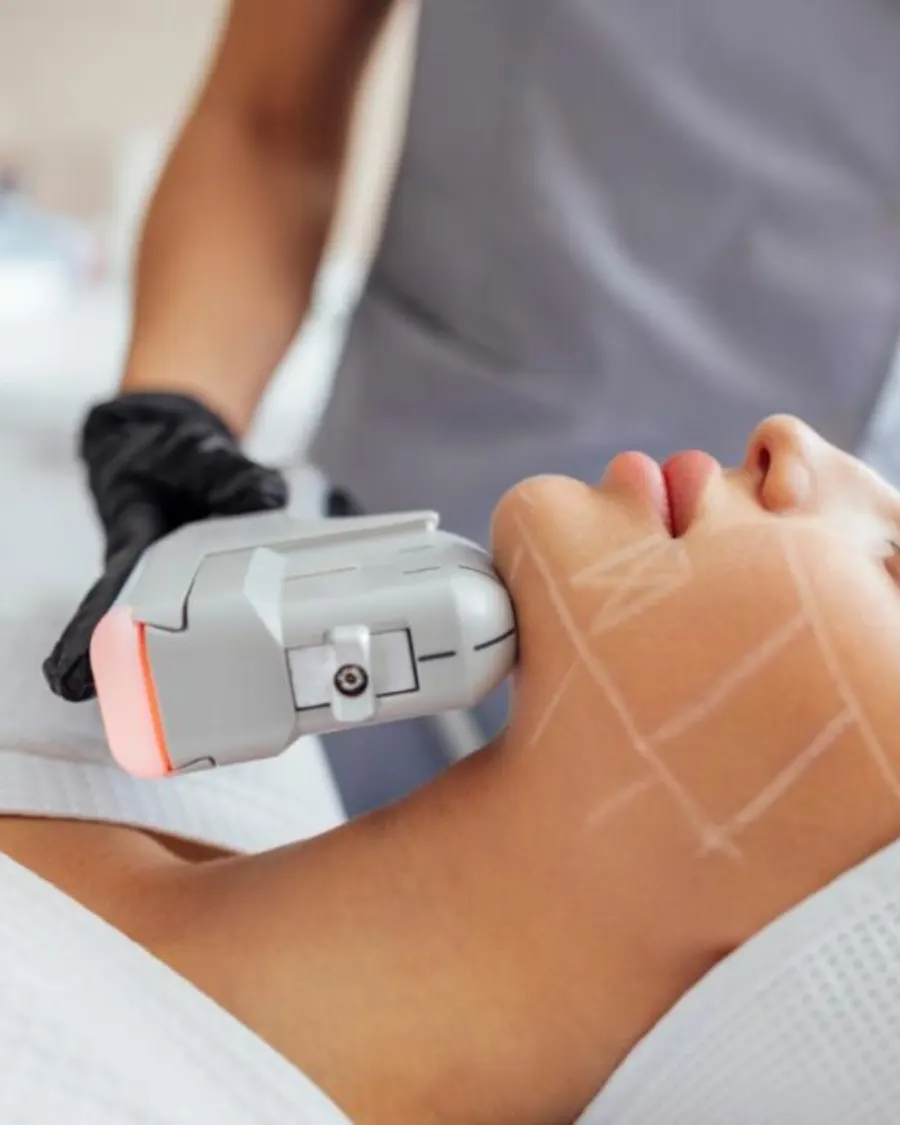 HIFU at Cinch Clinics